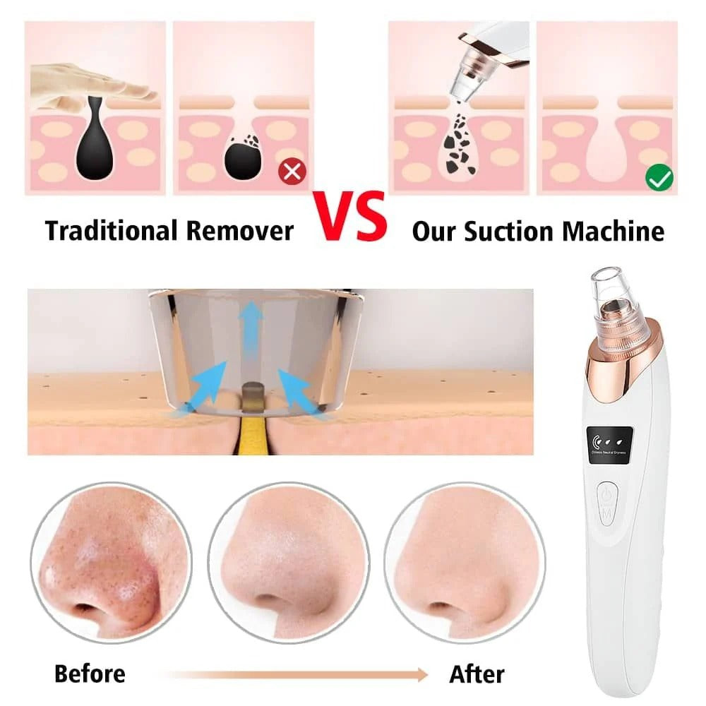 Electric Blackhead Remover | Vacuum Acne & Pore Cleaner | 5 Heads Suction Machin